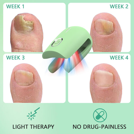 iKeener Nail Fungus Laser Treatment Device,Nail Laser Cleaning for Toenail Fingernails & Onychomycosis,Home Use Nail-Fungus Remover by 470nm Blue Light+660nm Red Light+905nm Infrared Light (Green)