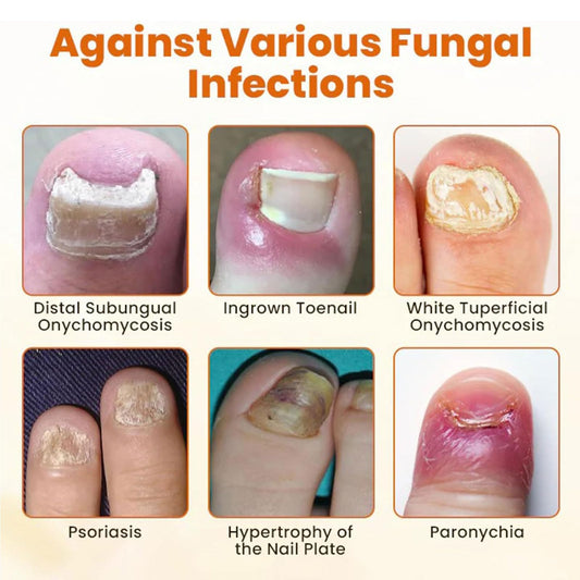 Nailvera Nail Fungal Treatment Spray, 2026 Best Nailvera Fungifix Bee Propolis & Bee Venom Nail Repair Spray, Antifungal Nail Fungus Treatment, Clear Nail Treatment for Toenail and Fingernail (2 Pcs)