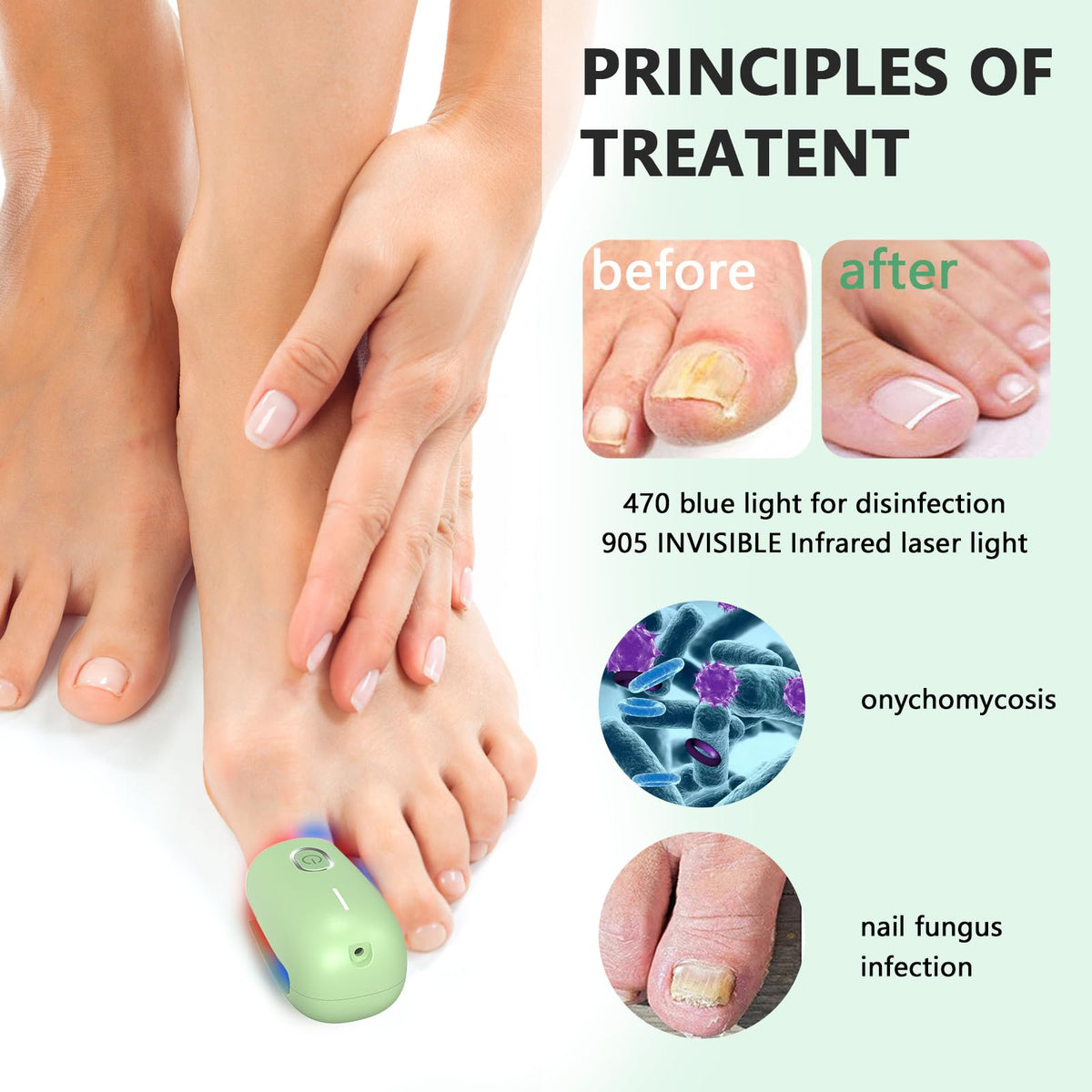 iKeener Nail Fungus Laser Treatment Device,Nail Laser Cleaning for Toenail Fingernails & Onychomycosis,Home Use Nail-Fungus Remover by 470nm Blue Light+660nm Red Light+905nm Infrared Light (Green)